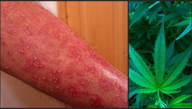 Cannabis gegen Psoriasis: Kann die Heilpflanze helfen?